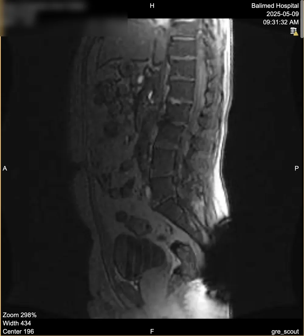 This lumbar spine MRI was performed as part of an investigation into chronic lower back pain experienced after more than 25 years of yoga practice and an active lifestyle that included tennis and surfing. The scan revealed age-related degenerative changes, including disc degeneration and facet joint arthritis, but no significant nerve compression requiring surgery. This image accompanies my personal story about navigating back pain, understanding MRI findings, and learning that imaging results do not always determine a person’s ability to move, exercise, and live an active life.