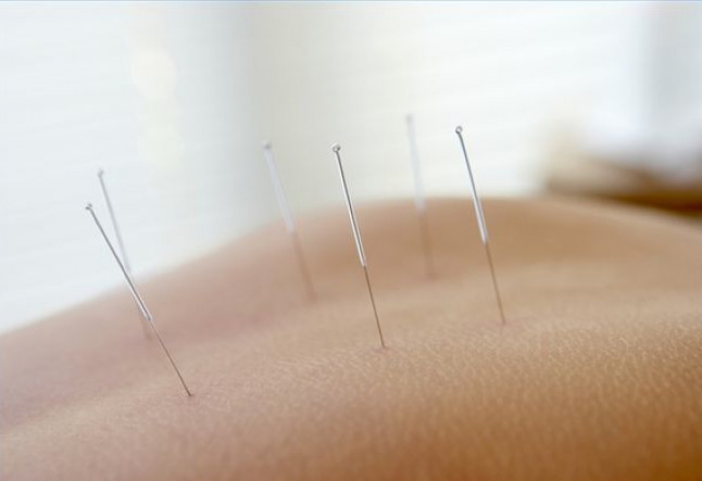 the amazing benefits of acupuncture